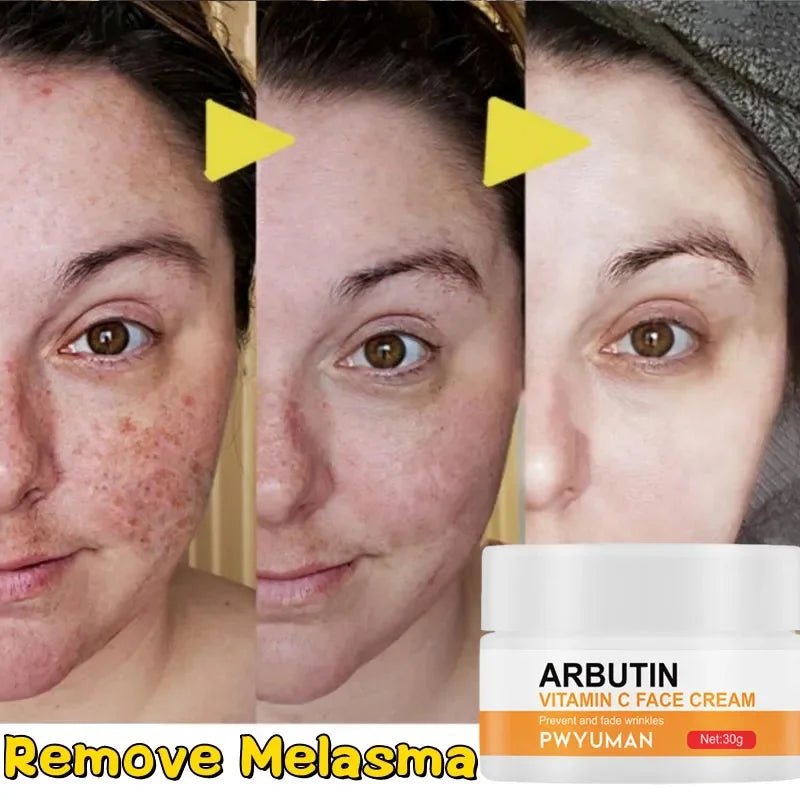 Whitening Anti Freckle Cream Effective Remove Melasma Serum Fade Dark Spots Melanin Moisturize Brighten Smooth Face Skin  Care